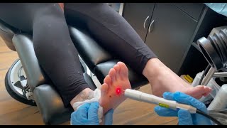 Laser Verruca Treatment Session 2  Birmingham UK [upl. by Melosa]