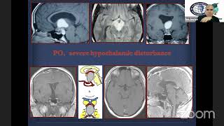 Craniopharyngioma [upl. by Gram140]