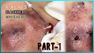 Big Cystic Acne Blackheads Extraction Blackheads amp Milia Whiteheads Removal Pimple Popping [upl. by Gregson]