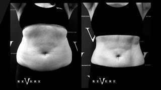 How Much Does CoolSculpting Cost [upl. by Raseta771]