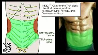 The UltrasoundGuided TAP Block [upl. by Hulburt810]