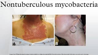 Nontuberculous mycobacteria [upl. by Ahsiam]