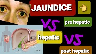 JAUNDICE  PRE HEPATIC VS POST HEPATIC JAUNDICE  DR SHAHRUKH [upl. by Adnyc344]