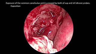 Endoscopic DCR tips amp tricks [upl. by Aerbma453]