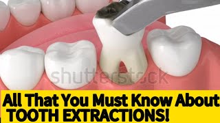 HOW TO EXTRACT A TOOTH  AN EASY CONSCISE GUIDE UK dentist USADENTAL [upl. by Kirschner]