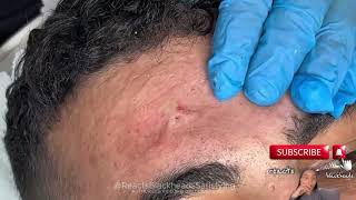 blackhead on forehead blackhead on forehead removal blackheads on forehead and nose [upl. by Libbna]