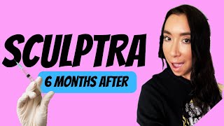 Sculptra 6 Months BeforeAfter 4 Vials Overview of My Experience sculptra collagen [upl. by Naitsabas227]