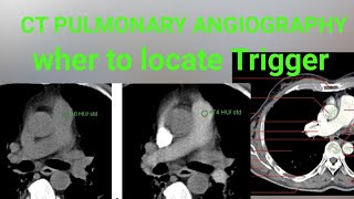 CTPA CT Pulmonary Angiography What You Need to Know wher to locket trigger [upl. by Frere]