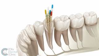 Endodontie  Wurzelbehandlung  City Dental Clinic Bratislava [upl. by Brantley811]