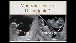 Monochorionic or dichorionic twins [upl. by Annamarie663]