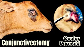 Conjunctivectomy  Dr Md Abu Bakar Ahad [upl. by Nibla]