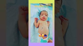 tracheoesophageal fistulanicu nicubaby viralvideo shorts 😍😍🥰🥰😘😘😘 [upl. by Fellows]