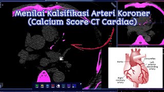 CT Cardiac Series 2  Calcium Score  Rekonstruksi dan Penilaian  Understanding Ca Score [upl. by Gnof552]