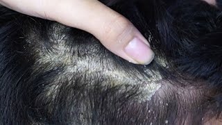 Dandruff scratching removal on head using black combing332 [upl. by Botzow593]