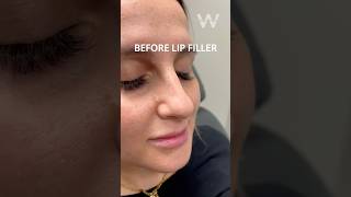 Before and after Restylane Kysse Lip Filler results [upl. by Euqinoj]