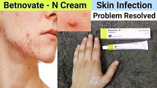 Betnovate N Cream Review  Benefits amp Uses  Betnovate N Cream for Face Acne Pimples [upl. by Rotkiv]