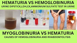 HOW TO DIFFERNTIATE HEMATURIA VS HEMOGLOBINURIA VS MYOGLOBINURIACAUSES URINE DIPSTICKLDH AND CK [upl. by Nyrmac]