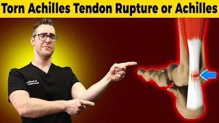 Torn Achilles Tendon Rupture or Achilles Tendonitis HOW TO TELL [upl. by Allemat]