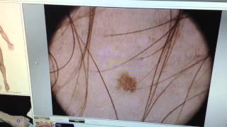 microfinder  microderm dermoscopy  diagnosis [upl. by Lesoj998]