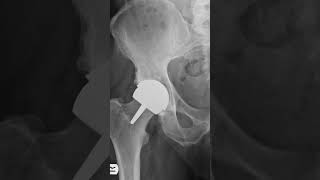 Ceramic on ceramic hip resurfacing [upl. by Uhsoj]