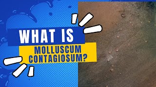 What is molluscum contagiosum [upl. by Adnilam635]