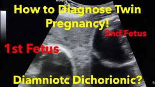 Twin Pregnancy  Diamniotic Dichorionic how to diagnose  easy steps [upl. by Eibreh]