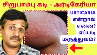 அர்டிகேரியா தோல் அழற்சி மருத்துவம்  urticaria hives skin allergy treatment [upl. by Nylacaj]