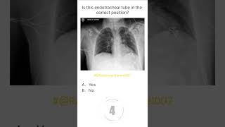 Chest Xray Buzz 33 radiologychannel007 [upl. by Llezo66]