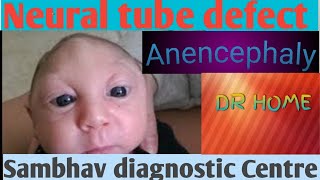 Anencephaly Neural tube defect Drshikha Agarwal Drhomeclass 12 biology [upl. by Gans755]