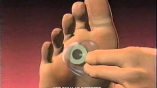 Dr Scholls Commercial 1996 Callus Removers Cushlin Advanced Pain Relief [upl. by Merrile]