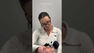 Elucells Skin Needling Treatment A Comprehensive Overview of Its Benefits [upl. by Kessia]