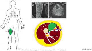 Soft Tissue Sarcoma [upl. by Aseena535]