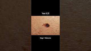 Melanoma Skin Cancer Development Time Lapse Normal to Stage 4 Melanoma Over 10 Years [upl. by Leinad]