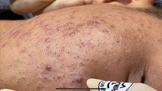 Blackheads amp Pimples Pore Removal New 2024  Acne Treatment With Bo Nguyễn Spa [upl. by Maon]