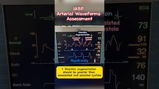 IABP Arterial Waveform Assessment cardiology criticalcare cathlab [upl. by Gladine]