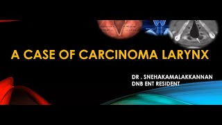 Case presentation  Carcinoma Larynx [upl. by Okiam]