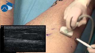 Marking hidden varicose veins for ultrasound guided phlebectomies [upl. by Jestude]