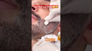 With or Without Beard  beardtransformation beardtransplant [upl. by Gonzalo178]