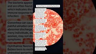 Neisseria gonorrhoeae is bacteria for gonorrhea sexually transmitted infection microbiology [upl. by Wolpert331]