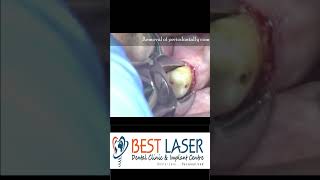 Receded molar and premolar extraction in 40 seconds by DrCMurugavel [upl. by Obau]