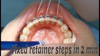 Fixed orthodontic retainer steps [upl. by Reibaj]