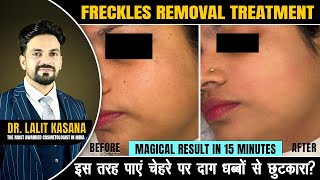 Freckles Removal Treatment  Magical Result in Minutes  DrLalit Kasana [upl. by Hafital323]