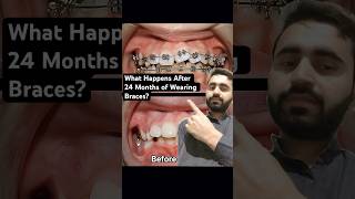 What Happens After 24 Months of Wearing Bracesdentist braces orthodontist dentistry [upl. by Freyah75]