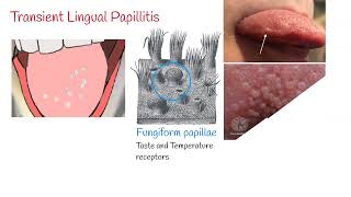 Transient lingual papillitis Lie Bumps  Inflammation of the tongue [upl. by Beaulieu]