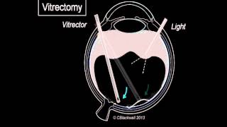 Vitreous 3 Vitrectomy Surgery [upl. by Irolam559]