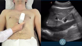 IVC Ultrasound  How to assess the IVC for volume status using ultrasound  Clarius Ultrasound [upl. by Oinesra]