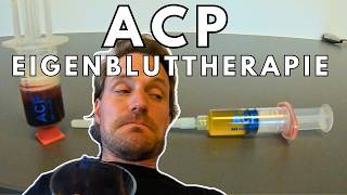 ACP Eigenbluttherapie für die Patellasehne  die erste Sitzung [upl. by Ilagam]