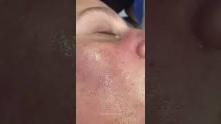 Clogged Pores amp how we unclog them  Dr Medispa [upl. by Evered]