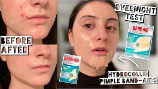 TESTING HYDROCOLLOID BANDAIDS FOR MY ACNE  Hydro Seal Patches  Week Test [upl. by Frierson]