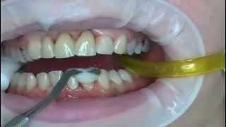 What are dental veneers [upl. by Adnuhs]